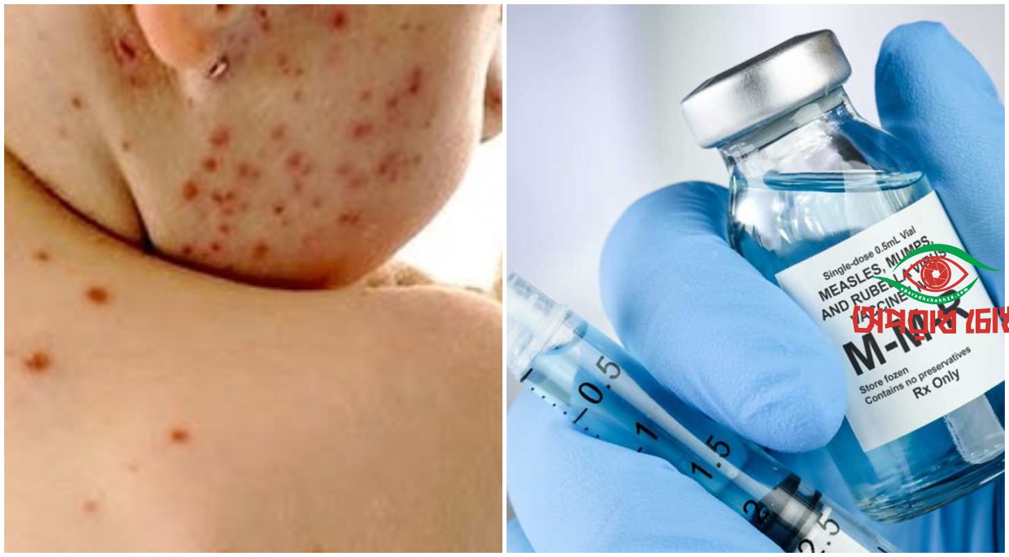 শুরু হচ্ছে জরুরি হাম-রুবেলা টিকাদান