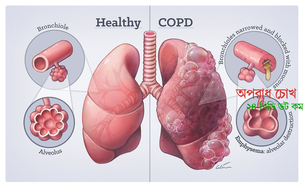 সিওপিডি সম্পর্কে যা না জানলেই নয়
