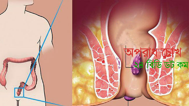 কীভাবে বুঝবেন পায়ুপথে ফিস্টুলা 