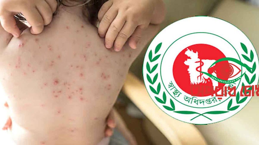 হাম ও উপসর্গ নিয়ে ১৭ জনের মৃত্যু